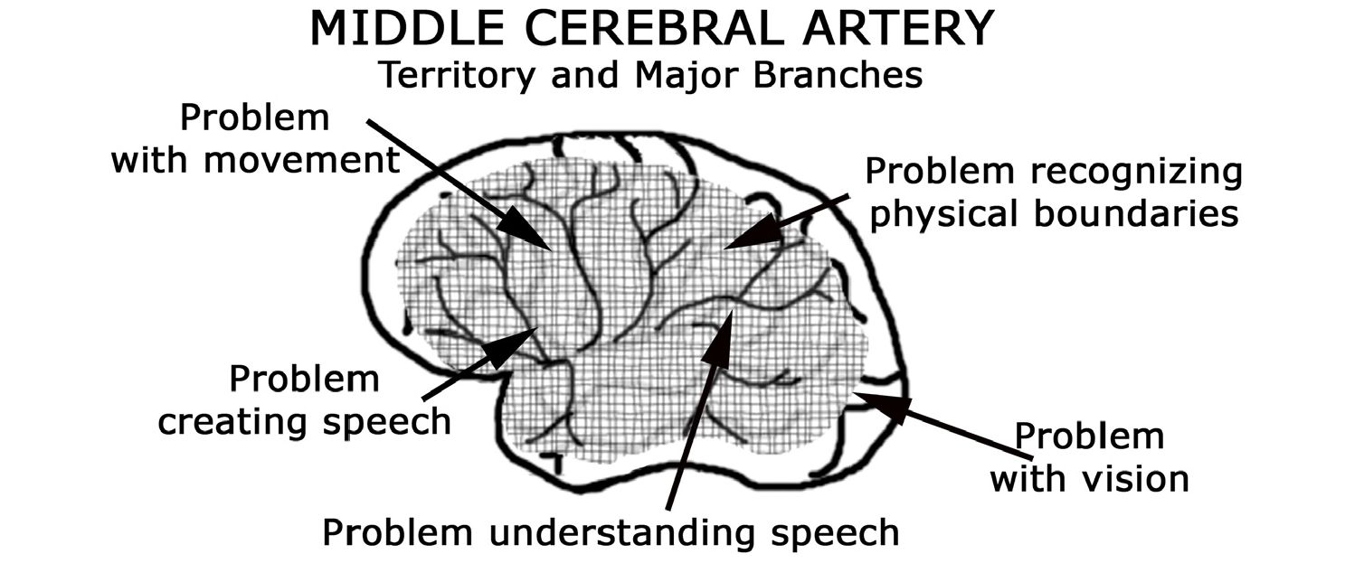 MIDDLE CEREBRAL ARTERY: ĐỘNG MẠCH NÃO GIỮA