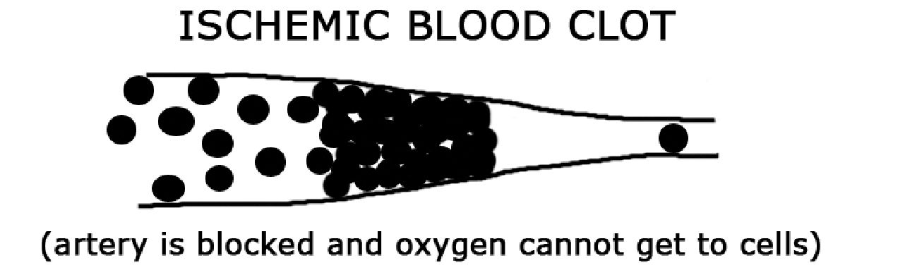 ISCHEMIC BLOOD CLOT: CỤC MÁU ĐÔNG GÂY THIẾU MÁU CỤC BỘ
