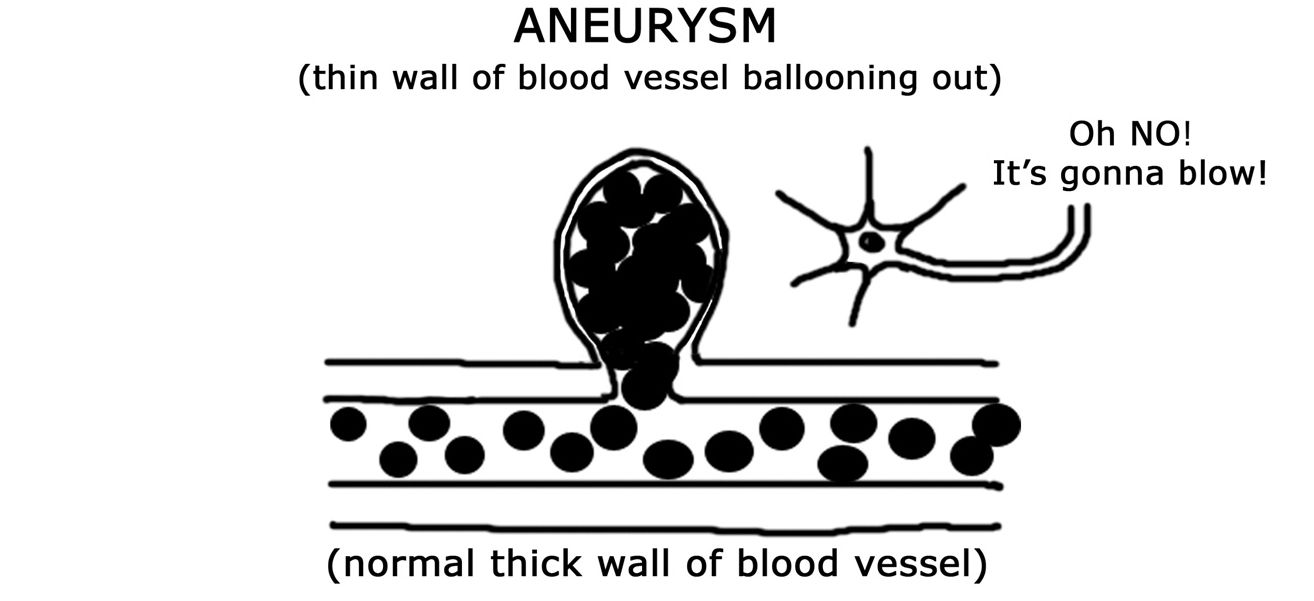 ANEURYSM: PHÌNH MẠCH